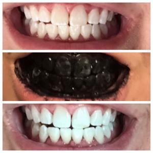 charcoal toothpaste before and after